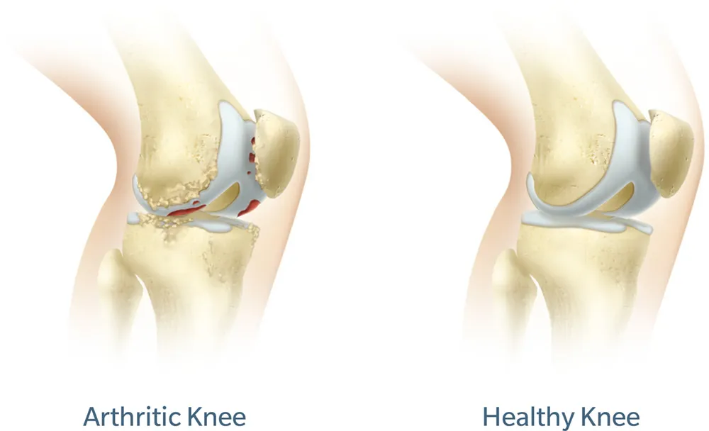 Comparing Arthritic Knee to a Healthy Knee